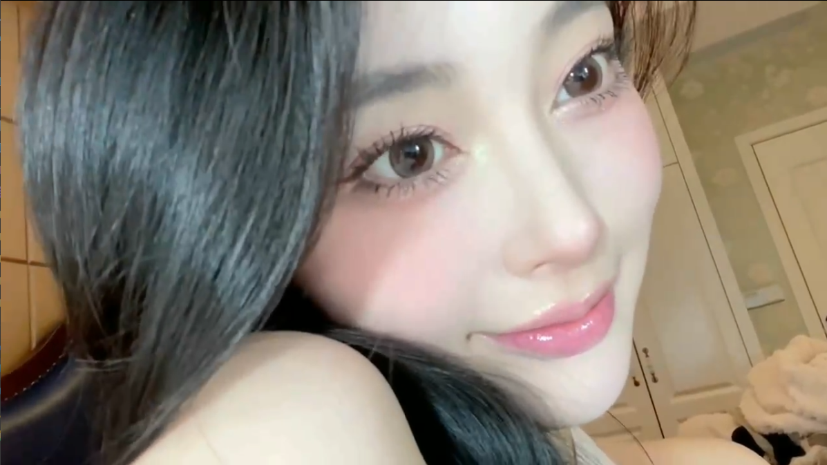 黄金媚眼重睑术效果【2】