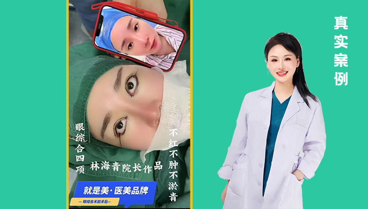眼综合四项